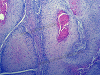 Squamous cell carcinoma of the esophagus sec